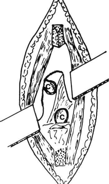150 REVISTA ESPAÑOLA DE CIRUGÍA OSTEOARTICULAR Figura 6. Posición de la guía para el orificio femoral.