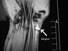 Figura 2: Imagen de resonancia nuclear magnética mostrando ganglión palmar de muñeca. Fig. 4: Ubicación de los gangliones con sus porcentajes.