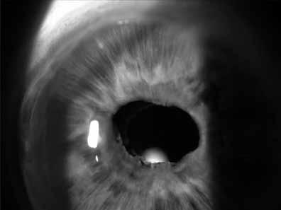 ZANETTI LLISA MR, et al. Fig. 3: Caso clínico 3: se aprecia un ojo pseudofáquico con atrofia sectorial del iris con deformidad de pupila. 0,4 en OI.