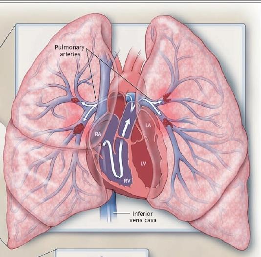Tromboembolismo pulmonar Principal mecanismo: bajo V/Q.
