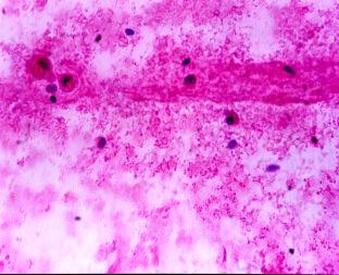 H-E 10X MICROFOTOGRAFÍA N 19 Histopatología: Carcinoma Adenoide Quístico, con patrón cribiforme (hacia la