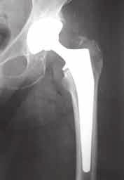La intervención quirúrgica La intervención quirúrgica consiste en reemplazar la articulación lesionada (figura 2) por una prótesis interna. de sangre residual.