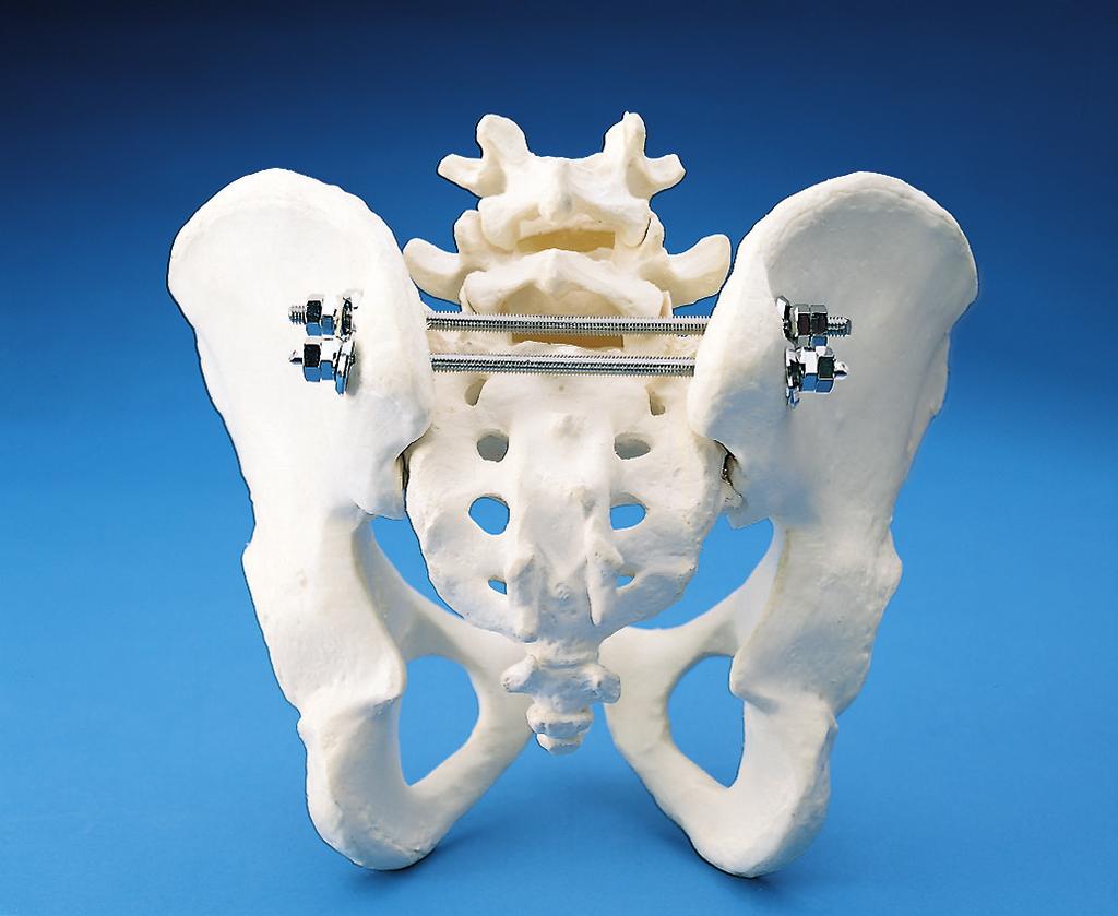 Barras sacras. Osteosíntesis pélvica posterior en casos de fractura o luxación sacroilíaca.