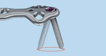 Los implantes se fabrican en acero y en aleación de titanio.