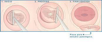 I-INTRODUCCION mayor frecuencia en el canal endocervical está indicado hacer un cono más profundo. Ilustración 17. Conización cervical.