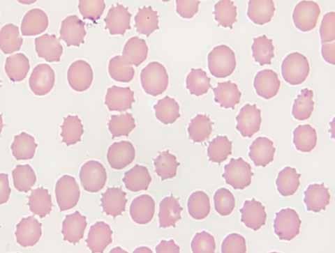 HEMATOLOGÍA glóbulos rojos 55Los equinocitos presentan múltiples protrusiones o espículas de márgenes redondeados, que pueden ser romas o puntiagudas, y
