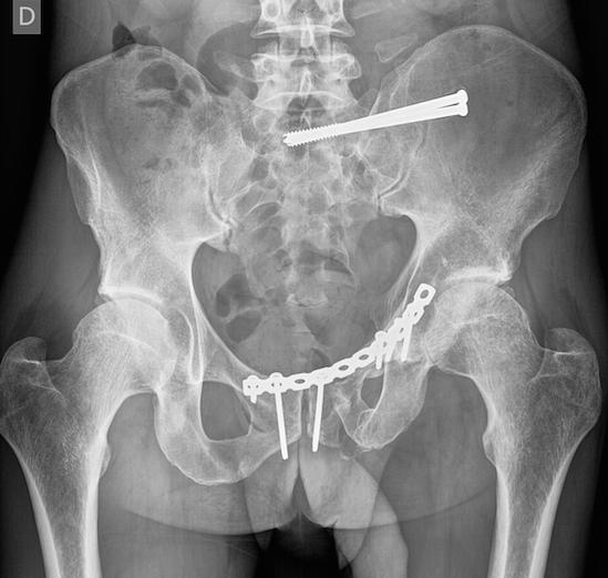 Rx AP pre-quirúrgica tomada con aparato portátil en la que se aprecian la disrupción sacroilíaca desplazada en vertical 20 mm y fractura de la rama púbica anterior. Figura 9.
