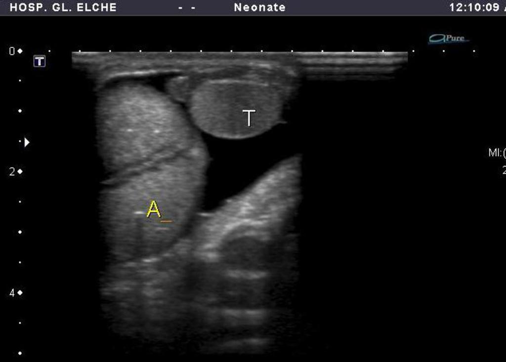 Fig. 9: Lactante de 4 meses con llanto incoercible y masa palpable escrotal derecha que resulta ser hernia inguinoescrotal con paso de
