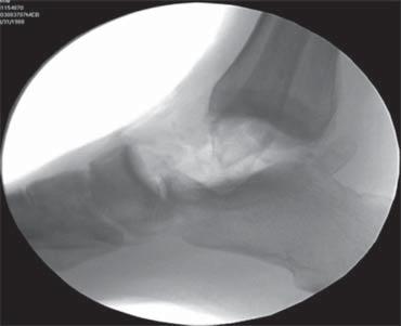 Se liberaron las inserciones ligamentarias, dejando intactos el ligamento peroneo calcáneo y la porción superficial del deltoideo.