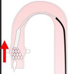Liberando la tensión del sistema: La posición del catéter a lo largo de la curvatura interna del cayado aórtico nos indica la