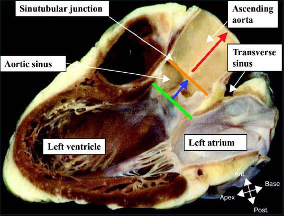 Anillo valvular aórtico This figure is from Surgical Anatomy of the Heart, 3 rd Edition, Benson R. Wilcox, UNC Hospitals, Andrew C.
