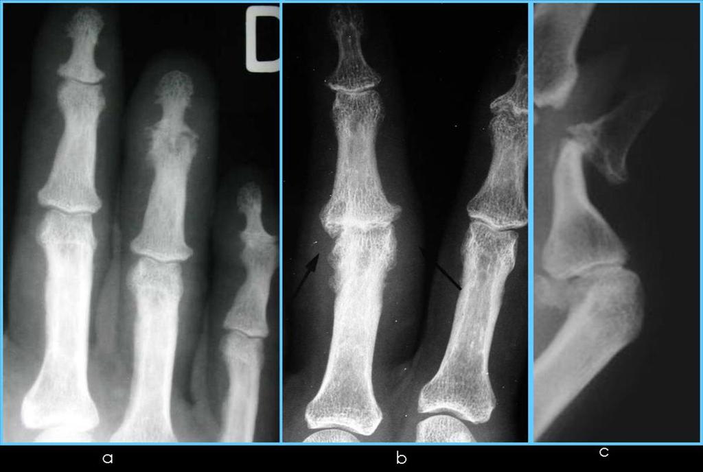 Fig. 13: Rx mano: a.afectación de IFD b.periostitis.dactilitis c.erosión "lápiz en copa" en formas mutilantes Referencias: M. Caba Cuevas; Hospital Universitario La Princesa, Madrid, SPAIN 2.
