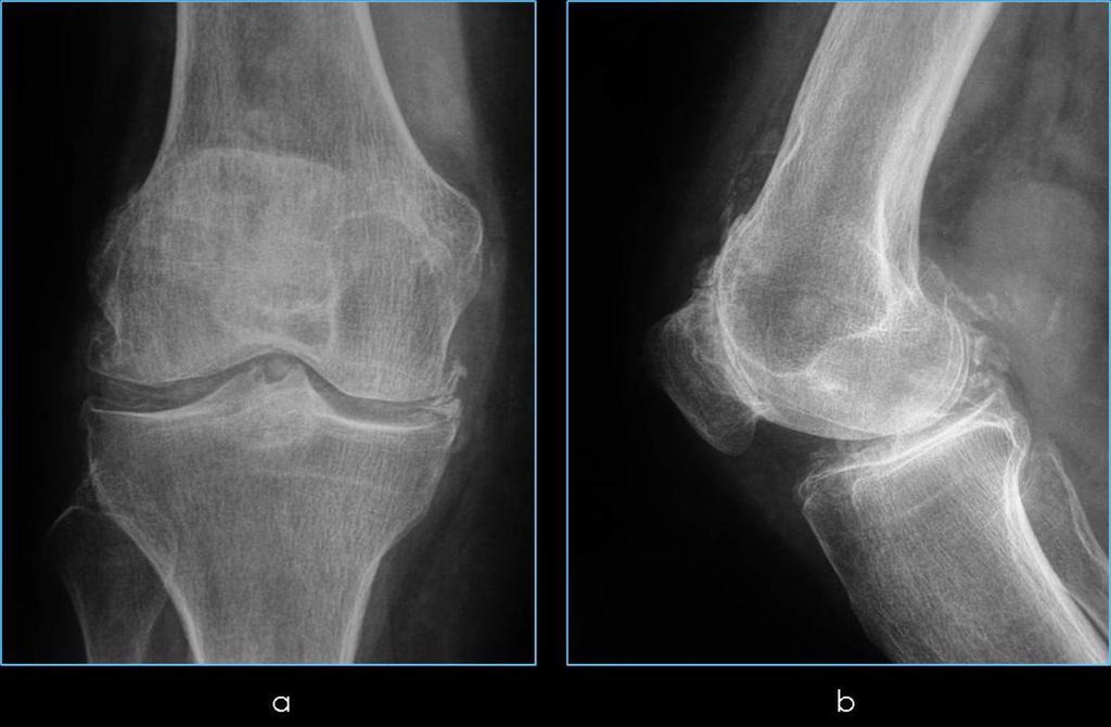 Osteoartrosis radiológica (osteofitos, formación de hueso subcondral, geodas) Fig. 16: Rx rodillas a.condrocalcinosis: calcificación en cuña paralela a los cóndilos femorales b.