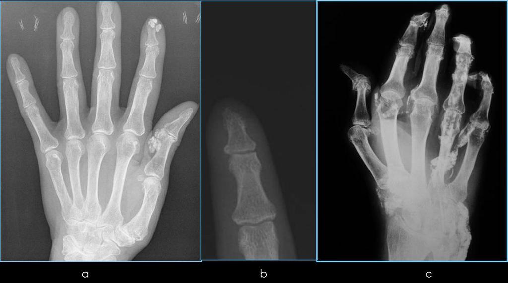 Atrofia de tejidos blandos en regiones distales de los dedos Fig. 17: Rx mano: a. Calcificaciones en partes blandas b. Acroosteólisis c. Atrofia de tejidos blandos.deformidades con subluxaciones.