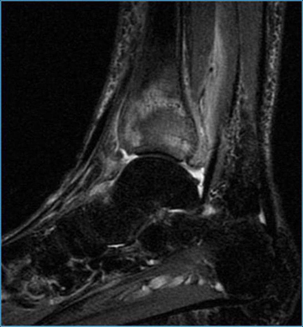 Fig. 33: RM de tobillo.sagital Stir.Área mal definida de aumento de señal en relación con foco de contusión ósea. Referencias: M.