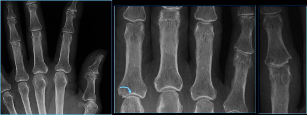 EROSIONES marginales (inicial)#severas y subcondrales (tardía) Aumento simétrico de partes blandas periarticulares Distribución de las lesiones en las manos (figuras 1 y 2) Hallazgos radiológicos en
