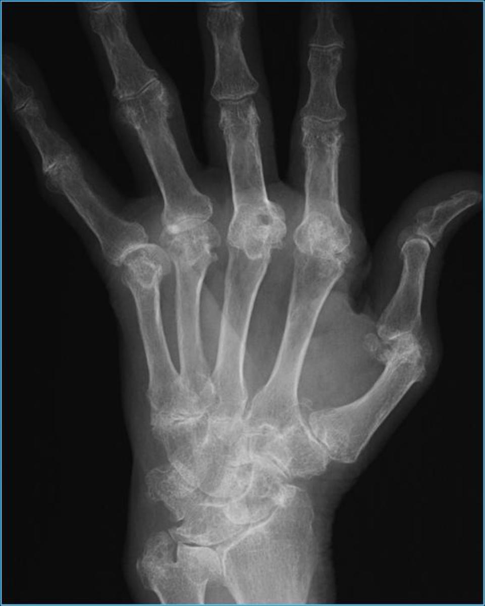 Fig. 4: Rx mano: Subluxaciones con desviación en ráfaga cubital,osteopenia difusa, disminución simétrica del espacio articular de