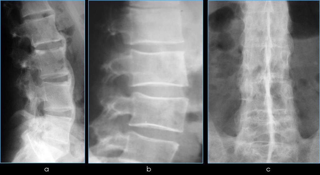 Fig. 12: Rx columna lumbar: a.sindesmofitos b.cuadratura de los cuerpos vertebrales c.osificación de los ligamentos. Columna "en caña de bambú" Referencias: M.