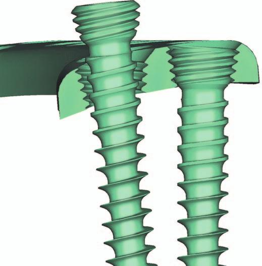 TSLP Thoracolumbar Spine Locking Plate. Placa anterior bloqueable para columna dorsolumbar.