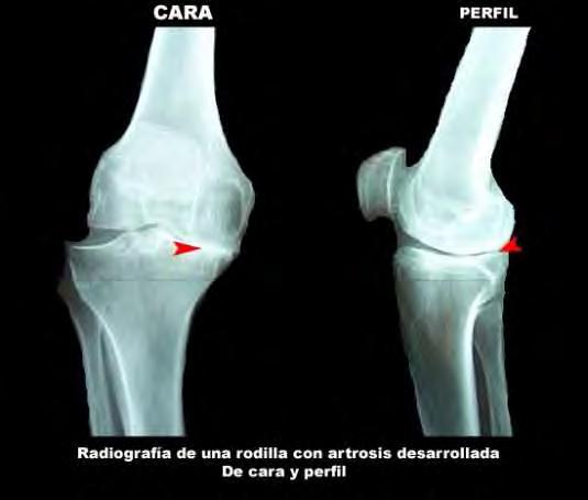 caderas Ejemplo: ARTROSIS Pérdida de la flexibilidad articular