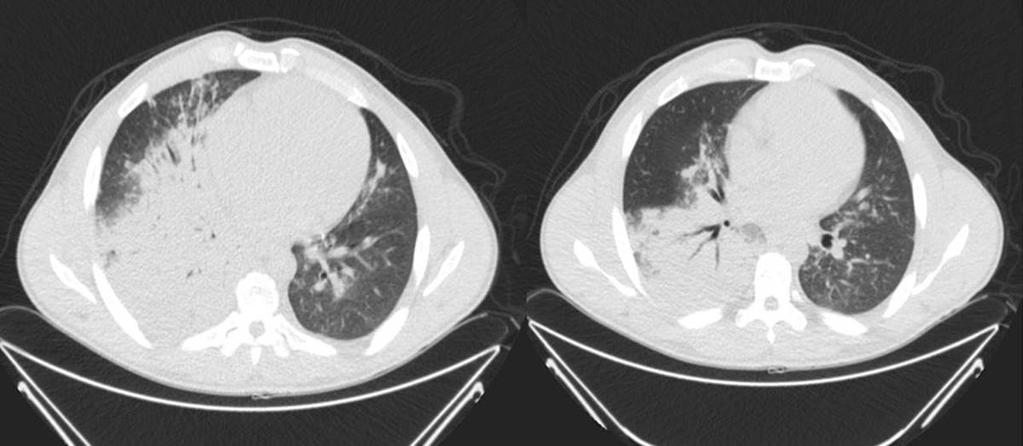 Fig. 14: En el TC de tórax sin contraste del paciente de la figura 13, en la ventana de parénquima se aprecia foco consolidativo con broncograma aéreo que afecta a todo el LID y LM.