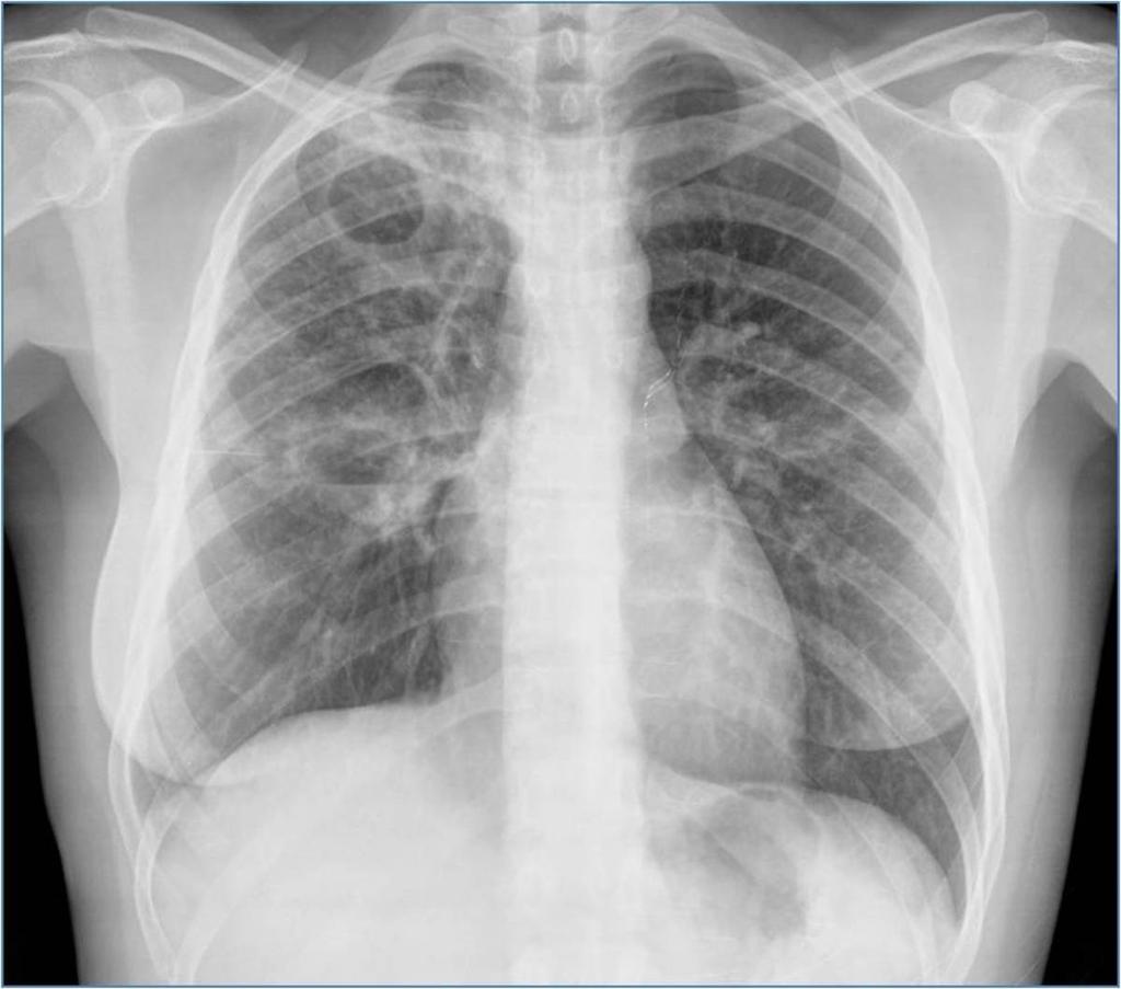 Fig. 21: Radiografía de tórax con lesiones cavitadas en campo superior y medio, alguna de