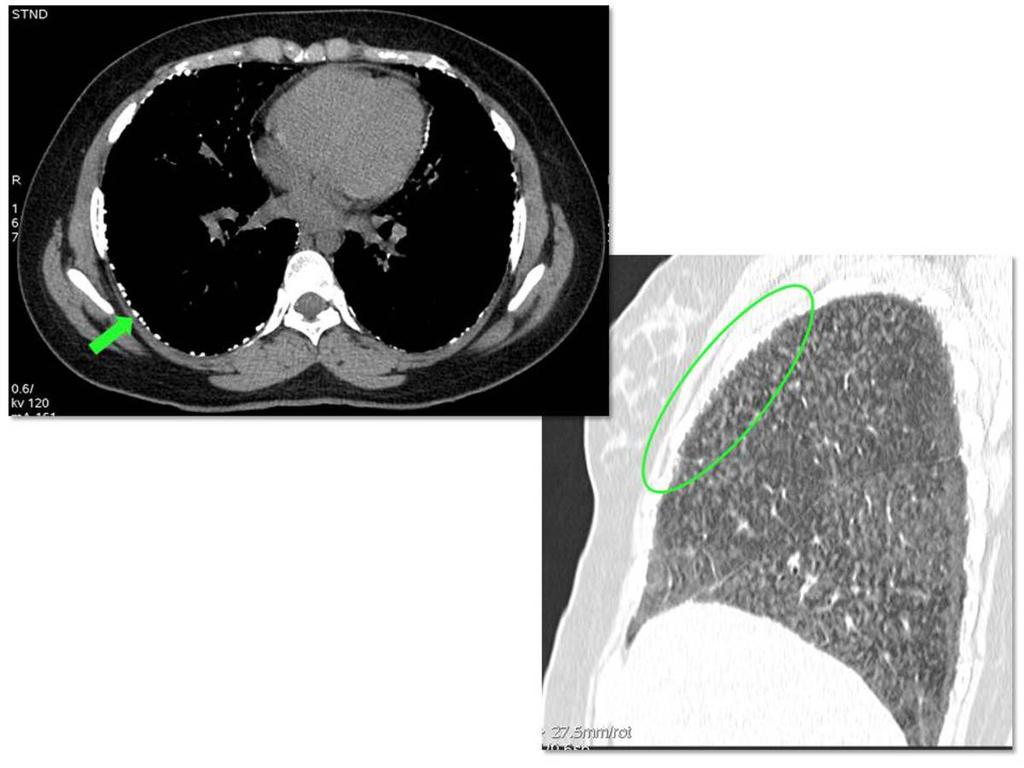Fig. 13: TC axial en ventana de mediastino y reconstrucción sagital en ventana de pulmón (caso