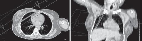 Irradiación complementaria de la mama tras una cirugía conservadora. La RT reduce el riesgo de recurrencia loco-regional postmastectomía en aproximadamente un 70% 12-14.