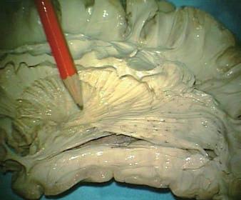 con el fascículo longitudinal inferior y las radiaciones ópticas en el stratum sagitale a nivel de la pared ventricular. Fig. 5.