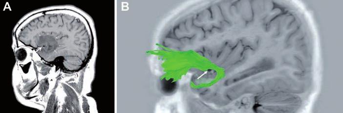 Controversias y evidencias en NEUROONCOLOGÍA Fig. 7. A: imagen sagital de RM, potenciada en T1, de una lesión de bajo grado temporal que se extiende al lóbulo frontal a través del fascículo uncinado.