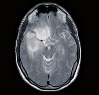 Imagen sagital de RM, potenciada en T1, de una lesión de bajo grado temporal que se extiende al lóbulo frontal a través de las fibras dorsolaterales del fascículo uncinado.