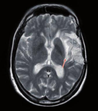 Imagen sagital de RM, potenciada en T1, de una lesión de bajo grado temporal que se extiende al lóbulo frontal a través de las fibras ventromediales de fascículo uncinado.