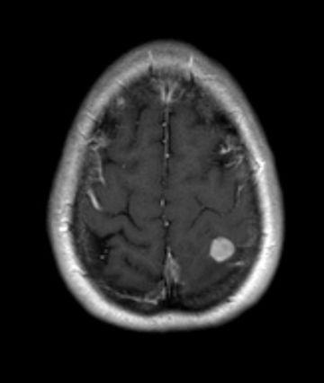 Julio 2014: exéresis metástasis en tránsito + micrometástasis IFN adyuvante (fin noviembre 2014) Progresión cerebral Enero 2015 SRS Febrero 2015 1er control tras radiocirugía (abril 2015): aumento de