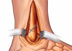 1. Exposición y abordaje: La incisión para una fractura maleolar lateral se realiza a través del aspecto lateral del peroné distal, entre la superficie peronea y la curvatura de los nervios surales,