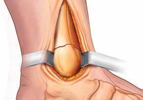 1. Exposición y abordaje: Para la aplicación de la placa LPL medial de tibia, la vía de abordaje recomendada es una incisión curvilínea sobre el aspecto medial del tobillo.