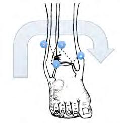 depende la estabilidad articular. Las fracturas del tobillo son el resultado de fuerzas que actúan sobre la articulación del tobillo y rompen el anillo articular (Figura 1).