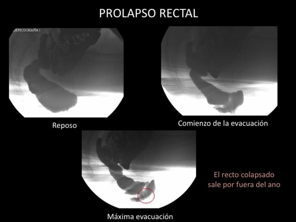 Fig. 11: Prolapso rectal (1).
