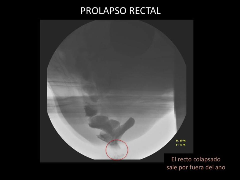 Fig. 13: Prolapso rectal (3).