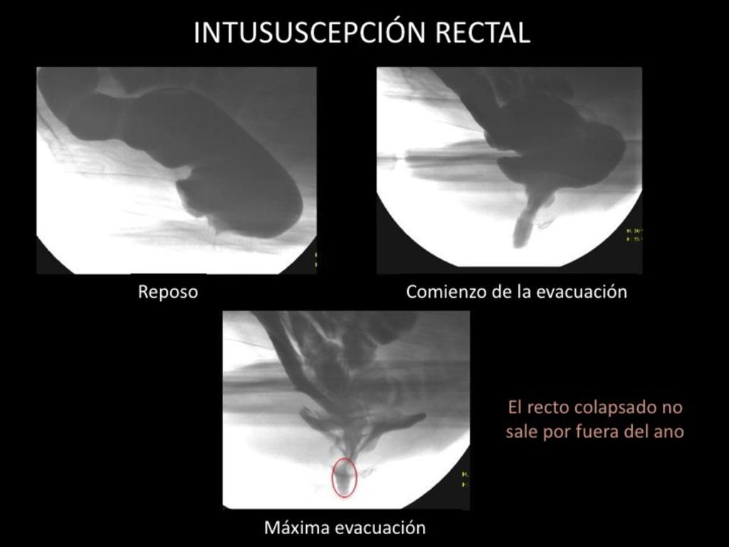 Fig. 14: Intususcepción rectal (1).