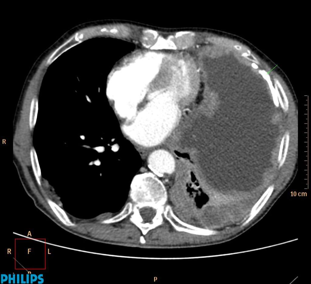 Fig. 9: Engrosamiento mamelonado, irregular e hipercaptante de la pleura derecha en un paciente con antecedente de exposición a asbesto (notese la