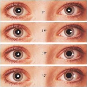7. ANEXO I: EXPLORACIÓN OFTALMOLÓGICA BÁSICA EDAD REVISIONES RN Globos oculares: forma tamaño y posición. Pupilas: posición, forma y color.