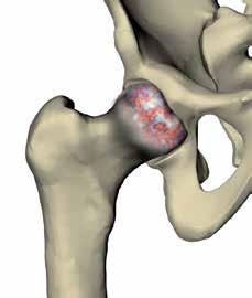 Cótilo o acetábulo (copa de la cadera) Cabeza femoral (bola de la cadera) Cartílago de la cadera normal La superficie de la cabeza femoral y del cótilo, en la que los huesos están en contacto entre
