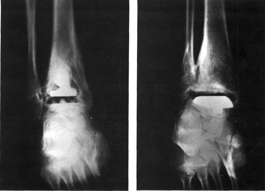 E. VILLANUEVA Y OTROS.- ARTROPLASTIA TOTAL DE TOBILLO 71 Figura 1. Control radiográfico en paciente con 13 años de evolución, intervenido por artrosis postraumática. Figura 2.
