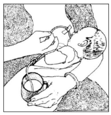 RELACTACIÓN Cuando un niño o niña es menor y se encuentra desnutrido, el personal de salud debe estimular la práctica de la lactancia materna por la importancia que la misma tiene y aportar un