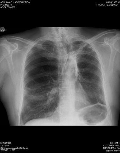 Radiografía de tórax - Hiperinsuflación Diafragma descendido 7 costilla