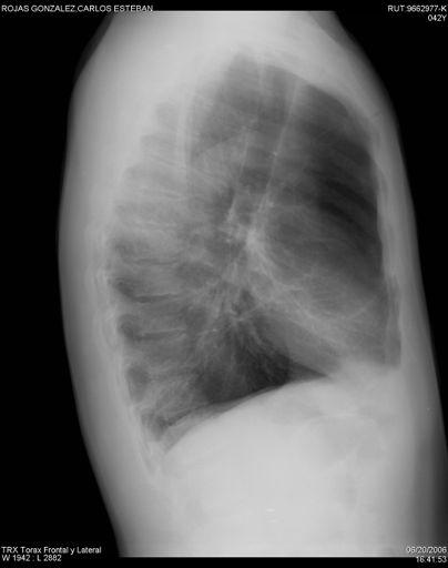 Radiografía de tórax - Hiperinsuflación Diafragma descendido 7 costilla Diafragma aplanado Domus < 1,5 cm - Cambios