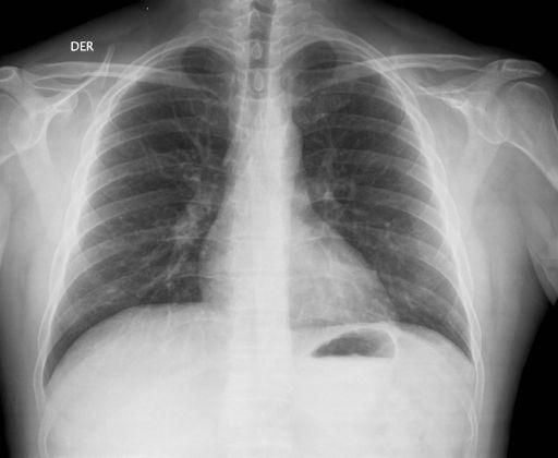 Vena cava superior Vena acigos Arteria pulmonar der. Tronco anterior Arteria pulmonar der.