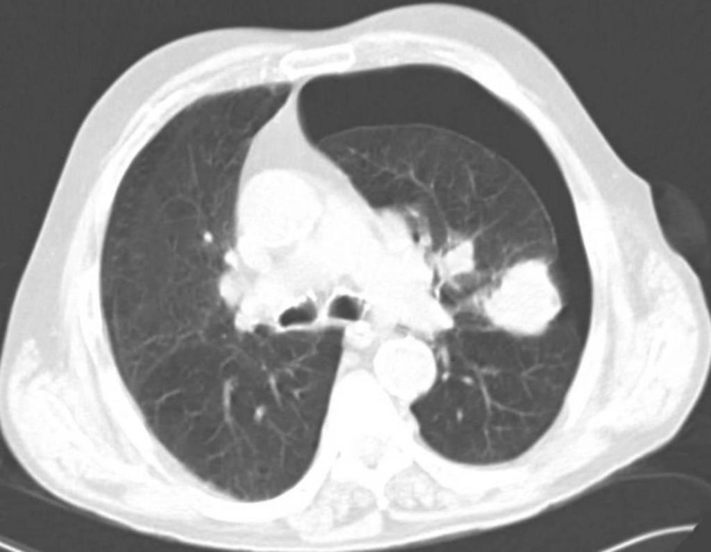 Fig. 6: Corte transversal de TC torácica de control tras PAAF pulmonar de la lesión mostrada en la Figura