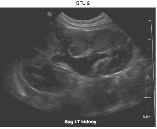 Clasificación de la Sociedad de Urología Fetal (SFU) Grado II: Visualización de pelvis y sólo algunos cálices.