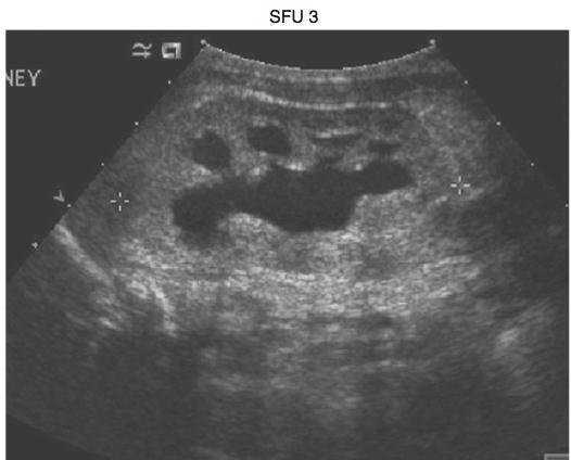 Clasificación de la Sociedad de Urología Fetal (SFU) Grado III: Visualización de pelvis y todos los cálices.